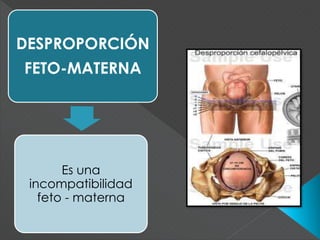 DESPROPORCIÓN
FETO-MATERNA
Es una
incompatibilidad
feto - materna
 