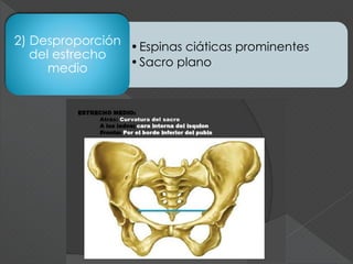 •Espinas ciáticas prominentes
•Sacro plano
2) Desproporción
del estrecho
medio
 