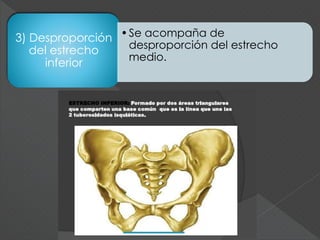 3) Desproporción
del estrecho
inferior
•Se acompaña de
desproporción del estrecho
medio.
 