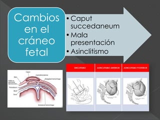 •Caput
succedaneum
•Mala
presentación
•Asinclitismo
Cambios
en el
cráneo
fetal
 