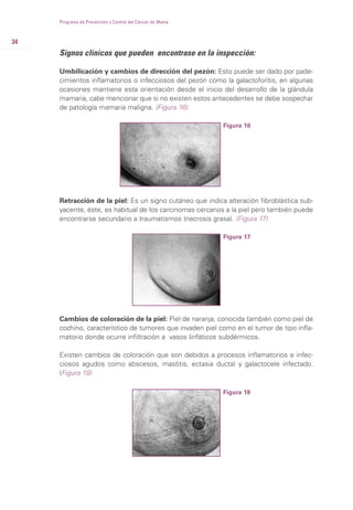 34
Programa de Prevención y Control del Cáncer de Mama
Signos clínicos que pueden encontrase en la inspección:
Umbilicación y cambios de dirección del pezón: Esto puede ser dado por pade-
cimientos inflamatorios o infecciosos del pezón como la galactoforítis, en algunas
ocasiones mantiene esta orientación desde el inicio del desarrollo de la glándula
mamaria, cabe mencionar que si no existen estos antecedentes se debe sospechar
de patología mamaria maligna. (Figura 16)
Figura 16
Retracción de la piel: Es un signo cutáneo que indica alteración fibroblástica sub-
yacente, éste, es habitual de los carcinomas cercanos a la piel pero también puede
encontrarse secundario a traumatismos (necrosis grasa). (Figura 17)
Figura 17
Cambios de coloración de la piel: Piel de naranja, conocida también como piel de
cochino, característico de tumores que invaden piel como en el tumor de tipo infla-
matorio donde ocurre infiltración a vasos linfáticos subdérmicos.
Existen cambios de coloración que son debidos a procesos inflamatorios e infec-
ciosos agudos como abscesos, mastitis, ectasia ductal y galactocele infectado.
(Figura 18)
Figura 18
 