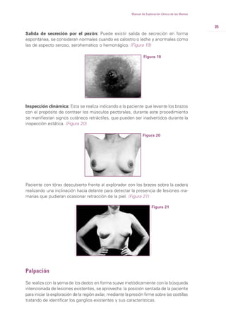 35
Manual de Exploración Clínica de las Mamas
Salida de secreción por el pezón: Puede existir salida de secreción en forma
espontánea, se consideran normales cuando es calostro o leche y anormales como
las de aspecto seroso, serohemático o hemorrágico. (Figura 19)
Figura 19
Inspección dinámica: Esta se realiza indicando a la paciente que levante los brazos
con el propósito de contraer los músculos pectorales, durante este procedimiento
se manifiestan signos cutáneos retráctiles, que pueden ser inadvertidos durante la
inspección estática. (Figura 20)
Figura 20
Paciente con tórax descubierto frente al explorador con los brazos sobre la cadera
realizando una inclinación hacia delante para detectar la presencia de lesiones ma-
marias que pudieran ocasionar retracción de la piel. (Figura 21)
Figura 21
Palpación
Se realiza con la yema de los dedos en forma suave metódicamente con la búsqueda
intencionada de lesiones existentes, se aprovecha la posición sentada de la paciente
para iniciar la exploración de la región axilar, mediante la presión firme sobre las costillas
tratando de identificar los ganglios existentes y sus características.
 
