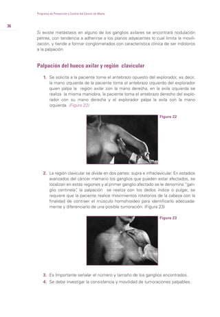 36
Si existe metástasis en alguno de los ganglios axilares se encontrará nodulación
pétrea, con tendencia a adherirse a los planos adyacentes lo cual limita la movili-
zación, y tiende a formar conglomerados con característica clínica de ser indoloros
a la palpación.
Palpación del hueco axilar y región clavicular
1. Se solicita a la paciente tome el antebrazo opuesto del explorador, es decir,
la mano izquierda de la paciente toma el antebrazo izquierdo del explorador
quien palpa la región axilar con la mano derecha, en la axila izquierda se
realiza la misma maniobra, la paciente toma el antebrazo derecho del explo-
rador con su mano derecha y el explorador palpa la axila con la mano
izquierda. (Figura 22)
Programa de Prevención y Control del Cáncer de Mama
Figura 22
Figura 23
2. La región clavicular se divide en dos partes: supra e infraclavicular. En estadios
avanzados del cáncer mamario los ganglios que pueden estar afectados, se
localizan en estas regiones y al primer ganglio afectado se le denomina “gan-
glio centinela”, la palpación se realiza con los dedos índice o pulgar, se
requiere que la paciente realice movimientos rotatorios de la cabeza con la
finalidad de contraer el músculo homohioideo para identificarlo adecuada-
mente y diferenciarlo de una posible tumoración. (Figura 23)
3. Es Importante señalar el número y tamaño de los ganglios encontrados.
4. Se debe investigar la consistencia y movilidad de tumoraciones palpables.
 
