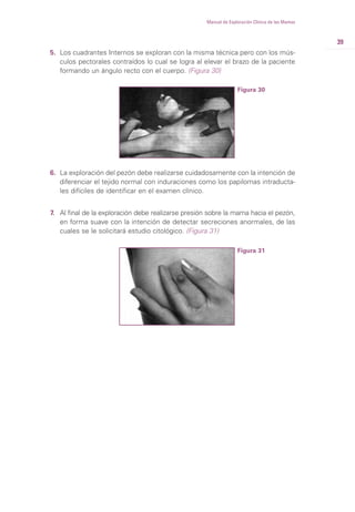 39
Manual de Exploración Clínica de las Mamas
5. Los cuadrantes Internos se exploran con la misma técnica pero con los mús-
culos pectorales contraídos lo cual se logra al elevar el brazo de la paciente
formando un ángulo recto con el cuerpo. (Figura 30)
Figura 30
6. La exploración del pezón debe realizarse cuidadosamente con la intención de
diferenciar el tejido normal con induraciones como los papilomas intraducta-
les difíciles de identificar en el examen clínico.
7. Al final de la exploración debe realizarse presión sobre la mama hacia el pezón,
en forma suave con la intención de detectar secreciones anormales, de las
cuales se le solicitará estudio citológico. (Figura 31)
Figura 31
 