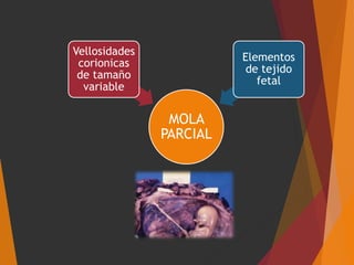 MOLA
PARCIAL
Vellosidades
corionicas
de tamaño
variable
Elementos
de tejido
fetal
 