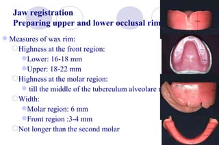 Registration Rims Clinical-and-laboratory-steps-of-Complete-denture.pdf