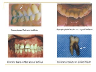 Clinical-diagnosis-Pathologic Tooth Migration | PPT