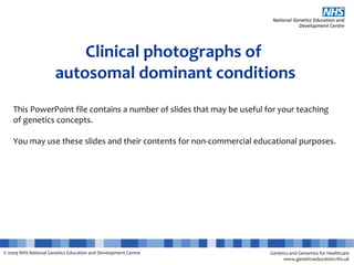 Genetics and Genomics for Healthcare
www.geneticseducation.nhs.uk
© 2009 NHS National Genetics Education and Development Centre
Clinical photographs of
autosomal dominant conditions
This PowerPoint file contains a number of slides that may be useful for your teaching
of genetics concepts.
You may use these slides and their contents for non-commercial educational purposes.
 
