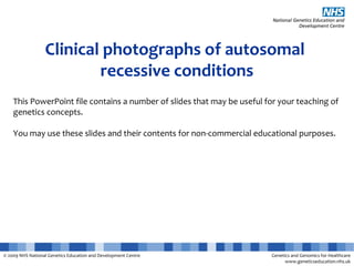 © 2009 NHS National Genetics Education and Development Centre Genetics and Genomics for Healthcare
www.geneticseducation.nhs.uk
Clinical photographs of autosomal
recessive conditions
This PowerPoint file contains a number of slides that may be useful for your teaching of
genetics concepts.
You may use these slides and their contents for non-commercial educational purposes.
 