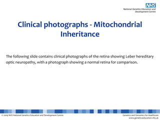 © 2009 NHS National Genetics Education and Development Centre Genetics and Genomics for Healthcare
www.geneticseducation.nhs.uk
Clinical photographs - Mitochondrial
Inheritance
The following slide contains clinical photographs of the retina showing Leber hereditary
optic neuropathy, with a photograph showing a normal retina for comparison.
 