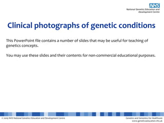 © 2009 NHS National Genetics Education and Development Centre Genetics and Genomics for Healthcare
www.geneticseducation.nhs.uk
Clinical photographs of genetic conditions
This PowerPoint file contains a number of slides that may be useful for teaching of
genetics concepts.
You may use these slides and their contents for non-commercial educational purposes.
 