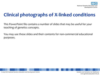 © 2009 NHS National Genetics Education and Development Centre Genetics and Genomics for Healthcare
www.geneticseducation.nhs.uk
Clinical photographs of X-linked conditions
This PowerPoint file contains a number of slides that may be useful for your
teaching of genetics concepts.
You may use these slides and their contents for non-commercial educational
purposes.
 