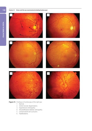 Clinical
Skills
for
OSCEs
138 Station 51 Vision and the eye examination(including fundoscopy)
Figure 31. 
Findings on fundoscopy of the right eye.
1. Normal.
2. Senile macular degeneration.
3. Hypertensive retinopathy.
4. Pre-proliferative diabetic retinopathy.
5. Central retinal vein occlusion.
6. Papilloedema.
1
3
5
2
4
6
Macula
Optic disc
Periphery
Blood vessels
06-OCSEs-Ophthalmology_5e ccp.indd 138 19/03/2015 07:23
 
