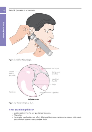 Clinical
Skills
for
OSCEs
142 Station 52 Hearing and the ear examination
Figure 33. Holding the auroscope.
Figure 34. The normal right ear drum.
After examining the ear
• Ask the patient if he has any questions or concerns.
• Thank him.
• Summarise your findings and offer a differential diagnosis, e.g. excessive ear wax, otitis media
with effusion (‘glue ear’), perforated ear drum.
Umbo
Manubrium
(handle)
Short process
of malleus
Junction
of incus
and stapes
Pars flaccida
Light reflex
Right ear drum
Pars tensa
06-OCSEs-Ophthalmology_5e ccp.indd 142 19/03/2015 07:23
 