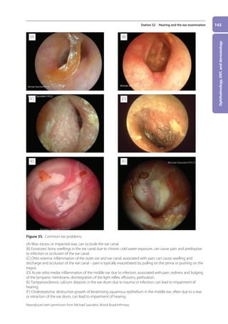 Ophthalmology,
ENT,
and
dermatology
143
Station 52 Hearing and the ear examination
Figure 35. Common ear problems.
(A) Wax: excess or impacted wax, can occlude the ear canal.
(B) Exostoses: bony swellings in the ear canal due to chronic cold water exposure, can cause pain and predispose
to infection or occlusion of the ear canal.
(C) Otitis externa: inflammation of the outer ear and ear canal, associated with pain, can cause swelling and
discharge and occlusion of the ear canal – pain is typically exacerbated by pulling on the pinna or pushing on the
tragus.
(D) Acute otitis media: inflammation of the middle ear due to infection, associated with pain, redness and bulging
of the tympanic membrane, disintegration of the light reflex, effusions, perforation.
(E) Tympanosclerosis: calcium deposits in the ear drum due to trauma or infection, can lead to impairment of
hearing.
(F) Cholesteatoma: destructive growth of keratinising squamous epithelium in the middle ear, often due to a tear
or retraction of the ear drum, can lead to impairment of hearing.
Reproduced with permission from Michael Saunders, Bristol Royal Infirmary.
(A) (B)
(D)
(C)
(E) (F)
06-OCSEs-Ophthalmology_5e ccp.indd 143 19/03/2015 07:23
 