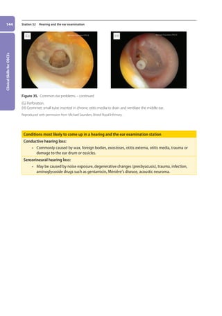Clinical
Skills
for
OSCEs
144 Station 52 Hearing and the ear examination
Conditions most likely to come up in a hearing and the ear examination station
Conductive hearing loss:
• commonly caused by wax, foreign bodies, exostoses, otitis externa, otitis media, trauma or
damage to the ear drum or ossicles.
Sensorineural hearing loss:
• may be caused by noise exposure, degenerative changes (presbyacusis), trauma, infection,
aminoglycoside drugs such as gentamicin, Ménière’s disease, acoustic neuroma.
Figure 35. Common ear problems – continued.
(G) Perforation.
(H) Grommet: small tube inserted in chronic otitis media to drain and ventilate the middle ear.
Reproduced with permission from Michael Saunders, Bristol Royal Infirmary.
(G) (H)
06-OCSEs-Ophthalmology_5e ccp.indd 144 19/03/2015 07:23
 