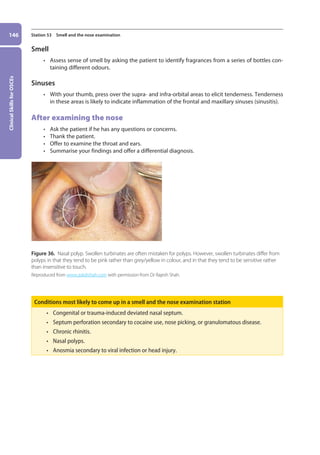Clinical
Skills
for
OSCEs
146 Station 53 Smell and the nose examination
Smell
• Assess sense of smell by asking the patient to identify fragrances from a series of bottles con-
taining different odours.
Sinuses
• With your thumb, press over the supra- and infra-orbital areas to elicit tenderness. Tenderness
in these areas is likely to indicate inflammation of the frontal and maxillary sinuses (sinusitis).
After examining the nose
• Ask the patient if he has any questions or concerns.
• Thank the patient.
• Offer to examine the throat and ears.
• Summarise your findings and offer a differential diagnosis.
Figure 36. Nasal polyp. Swollen turbinates are often mistaken for polyps. However, swollen turbinates differ from
polyps in that they tend to be pink rather than grey/yellow in colour, and in that they tend to be sensitive rather
than insensitive to touch.
Reproduced from www.askdrshah.com with permission from Dr Rajesh Shah.
Conditions most likely to come up in a smell and the nose examination station
• Congenital or trauma-induced deviated nasal septum.
• Septum perforation secondary to cocaine use, nose picking, or granulomatous disease.
• Chronic rhinitis.
• Nasal polyps.
• Anosmia secondary to viral infection or head injury.
06-OCSEs-Ophthalmology_5e ccp.indd 146 19/03/2015 07:23
 