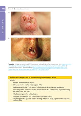 Clinical
Skills
for
OSCEs
154 Station 56 Dermatological examination
Figure 38. (A) Basal cell carcinoma (BCC). Reproduced under a Creative Commons License from: http://commons.
wikimedia.org/wiki/Category:Basal-cell_carcinoma#mediaviewer/File:Basaliom_am_Nasenrücken_2.JPG. (B)
Squamous cell carcinoma. Reproduced from http://commons.wikimedia.org/wiki/Category:Squamous-cell_
carcinoma_of_the_skin#mediaviewer/File:Squamous_Cell_Carcinoma.jpg
Conditions most likely to come up in a dermatological examination station
Psoriasis:
• chronic, autoimmune skin disease.
• plaque psoriasis is most common type (c. 90%).
• red plaques with silvery scales due to inflammation and excessive skin production.
• frequently on the extensor aspects of elbows or knees, but can also affect any area including
the scalp, palms, and soles.
• may be accompanied by nail dystrophy.
• may be accompanied by joint inflammation (psoriatic arthritis).
• may be aggravated by stress, alcohol, smoking, and certain drugs, e.g. lithium, beta blockers,
chloroquinine.
(A)
(B)
06-OCSEs-Ophthalmology_5e ccp.indd 154 19/03/2015 07:23
 