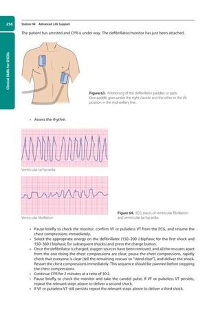 Clinical
Skills
for
OSCEs
256 Station 94 Advanced Life Support
The patient has arrested and CPR is under way. The defibrillator/monitor has just been attached.
• Assess the rhythm.
• Pause briefly to check the monitor, confirm VF or pulseless VT from the ECG, and resume the
chest compressions immediately.
• Select the appropriate energy on the defibrillator (150–200 J biphasic for the first shock and
150–360 J biphasic for subsequent shocks) and press the charge button.
• Once the defibrillator is charged, oxygen sources have been removed, and all the rescuers apart
from the one doing the chest compressions are clear, pause the chest compressions, rapidly
check that everyone is clear (tell the remaining rescuer to “stand clear”), and deliver the shock.
Restart the chest compressions immediately. This sequence should be planned before stopping
the chest compressions.
• Continue CPR for 2 minutes at a ratio of 30:2.
• Pause briefly to check the monitor and take the carotid pulse. If VF or pulseless VT persists,
repeat the relevant steps above to deliver a second shock.
• If VF or pulseless VT still persists repeat the relevant steps above to deliver a third shock.
Ventricular tachycardia
Ventricular fibrillation
Figure 63. Positioning of the defibrillator paddles or pads.
One paddle goes under the right clavicle and the other in the V6
position in the mid-axillary line.
Figure 64. ECG traces of ventricular fibrillation
and ventricular tachycardia.
10-OCSEs-Emergency_Medicine_5e ccp.indd 256 19/03/2015 13:32
 
