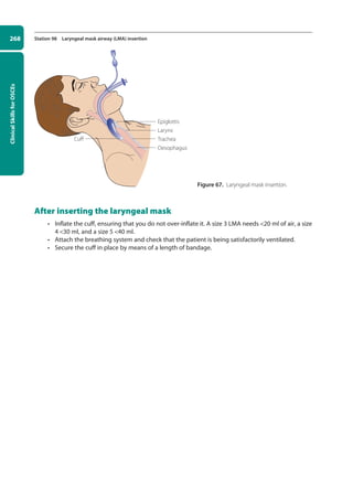 Clinical
Skills
for
OSCEs
268 Station 98 Laryngeal mask airway (LMA) insertion
After inserting the laryngeal mask
• Inflate the cuff, ensuring that you do not over-inflate it. A size 3 LMA needs 20 ml of air, a size
4 30 ml, and a size 5 40 ml.
• Attach the breathing system and check that the patient is being satisfactorily ventilated.
• Secure the cuff in place by means of a length of bandage.
Larynx
Trachea
Epiglottis
Cuff
Oesophagus
Figure 67. Laryngeal mask insertion.
10-OCSEs-Emergency_Medicine_5e ccp.indd 268 19/03/2015 13:32
 