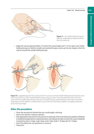 Emergency
medicine
and
anaesthesiology
279
Station 103 Wound suturing
• Apply the sutures approximately 3 mm from the wound edge and 5–10 mm apart. Use needle-
holding forceps to hold the needle and toothed forceps to pick up the skin margins. Knot the
sutures around the needle-holding forceps.
Figure 72. Suggested approach for suturing. Knot the sutures around the needle-holding forceps: loop the suture
twice around the nose of the needle-holding forceps using your hand. Then take hold of the short end of the
suture with the needle-holding forceps and carry it through the loops, gently pulling the knot tight. Two further
single loops are then added in a similar fashion to secure the knot. Each loop is pulled in the opposite direction
across the wound edge.
After the procedure
• Clean the wound and indicate that you would apply a dressing.
• Assess the need for a tetanus injection.
• Giveappropriateinstructionsforwoundcare(inparticular,ifthewoundbecomespainfulorinflamed,
itshouldbebroughtbacktomedicalattention),andindicatethedateonwhichthesuturesshouldbe
removed (e.g. face 3–4 days, scalp 5 days, trunk 7 days, limbs 7–10 days, feet 10–14 days).
• Ask if the patient has any questions or concerns.
• Thank him.
Figure 71. Use needle-holding forceps to
hold the needle approximately two-thirds
from the needle tip.
10-OCSEs-Emergency_Medicine_5e ccp.indd 279 19/03/2015 13:32
 