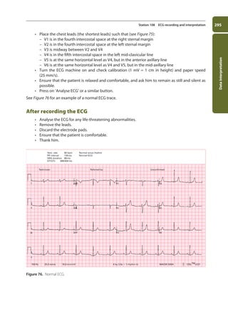 Data
interpretation
295
Station 108 ECG recording and interpretation
• Place the chest leads (the shortest leads) such that (see Figure 75):
–
– V1 is in the fourth intercostal space at the right sternal margin
–
– V2 is in the fourth intercostal space at the left sternal margin
–
– V3 is midway between V2 and V4
–
– V4 is in the fifth intercostal space in the left mid-clavicular line
–
– V5 is at the same horizontal level as V4, but in the anterior axillary line
–
– V6 is at the same horizontal level as V4 and V5, but in the mid-axillary line
• Turn the ECG machine on and check calibration (1 mV = 1 cm in height) and paper speed
(25 mm/s).
• Ensure that the patient is relaxed and comfortable, and ask him to remain as still and silent as
possible.
• Press on ‘Analyse ECG’ or a similar button.
See Figure 76 for an example of a normal ECG trace.
After recording the ECG
• Analyse the ECG for any life-threatening abnormalities.
• Remove the leads.
• Discard the electrode pads.
• Ensure that the patient is comfortable.
• Thank him.
Figure 76. Normal ECG.
I aVR V1 V4
aVL V2 V5
aVF V3 V6
II
III
II
150 Hz 25.0 mm/s 10.0 mm/mV 4 by 2.5s  1 rhythm ld MAC5K 005A 12SLTMv231


o
Technician
Vent. rate 66 bpm
PR intervel 134ms
QRS duration 88ms
QT/QTc 388/406 ms
Referred by:
Normal sinus rhythm
Normal ECG
Unconfirmed
11-OCSEs-Data_interpretation_5e ccp.indd 295 19/03/2015 13:39
 