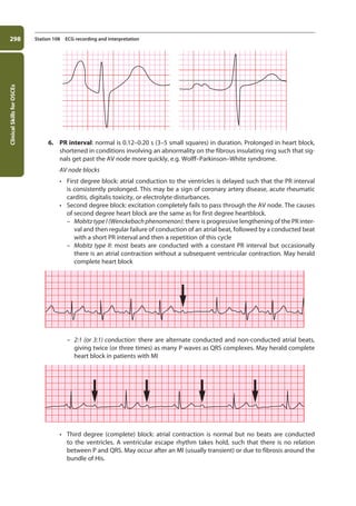 Clinical
Skills
for
OSCEs
298 Station 108 ECG recording and interpretation
6. PR interval: normal is 0.12–0.20 s (3–5 small squares) in duration. Prolonged in heart block,
shortened in conditions involving an abnormality on the fibrous insulating ring such that sig-
nals get past the AV node more quickly, e.g. Wolff–Parkinson–White syndrome.
AV node blocks
• First degree block: atrial conduction to the ventricles is delayed such that the PR interval
is consistently prolonged. This may be a sign of coronary artery disease, acute rheumatic
carditis, digitalis toxicity, or electrolyte disturbances.
• Second degree block: excitation completely fails to pass through the AV node. The causes
of second degree heart block are the same as for first degree heartblock.
–
– Mobitz type I (Wenckebach phenomenon): there is progressive lengthening of the PR inter-
val and then regular failure of conduction of an atrial beat, followed by a conducted beat
with a short PR interval and then a repetition of this cycle
–
– Mobitz type II: most beats are conducted with a constant PR interval but occasionally
there is an atrial contraction without a subsequent ventricular contraction. May herald
complete heart block
–
– 2:1 (or 3:1) conduction: there are alternate conducted and non-conducted atrial beats,
giving twice (or three times) as many P waves as QRS complexes. May herald complete
heart block in patients with MI
• Third degree (complete) block: atrial contraction is normal but no beats are conducted
to the ventricles. A ventricular escape rhythm takes hold, such that there is no relation
between P and QRS. May occur after an MI (usually transient) or due to fibrosis around the
bundle of His.
11-OCSEs-Data_interpretation_5e ccp.indd 298 19/03/2015 13:39
 