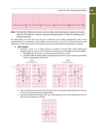 Data
interpretation
299
Station 108 ECG recording and interpretation
[Note] HeartblockthatisMobitztypeIIoraboveismuchmorelikelytoinvolvehaemodynamiccompromise,andrequires
pacing. The choice between a temporary or permanent pacemaker depends on whether the underlying cause is
transient or permanent.
SA node blocks can also occur but they are uncommon and usually asymptomatic (due to the
establishment of a ventricular escape rhythm). SA node block is not to be confused with SA node
suppression, which occurs when an arrhythmia prevents the SA node from generating an impulse.
7. QRS complex:
a. Normal is 0.12 s or 3 small squares in duration. A broad QRS results either from
depolarisation by a focus in the ventricular muscle or from a bundle branch block (BBB).
i. Right BBB: can be normal, or may be caused by IHD, PE, or ASD.
ii. Left BBB: LBBB invariably reflects underlying heart disease, but its presence precludes
further interpretation of the ECG.
RBBB
characteristics
LBBB
characteristics
V1
rSR’ qRs
V6 V1
rS
R
V6
b. The sum of the S wave in V2 and an R wave in V5 or V6 should not be greater than 35 mm.
If it is, this indicates ventricular hypertrophy.
c. Q waves should not be deeper than two small squares or 25% of the following R wave. If
they are, this indicates an old MI.
11-OCSEs-Data_interpretation_5e ccp.indd 299 19/03/2015 13:39
 