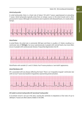 Data
interpretation
301
Station 108 ECG recording and interpretation
Atrial tachycardia
In atrial tachycardia, there is a heart rate of about 150 with P waves superimposed on preceding
T waves. Atrial tachycardia typically arises from an ectopic source in the atrial muscle and is often
paroxysmal in nature. Although it is sometimes seen in patients with diseased hearts, it is nearly always
benign.
Atrial flutter
In atrial flutter, the atrial rate is commonly 300 bpm and there is usually a 2:1 block, resulting in a
ventricular rate of 150 bpm. Can occur spontaneously in people with normal hearts, but most often
occurs in people with cardiovascular disease. Frequently degenerates into AF.
Atrial flutter with variable (2:1 and 3:1) block. Fast P waves produce a ‘saw-tooth’ appearance.
Atrial fibrillation (AF)
AF is associated with any disease affecting the heart. There is an ‘irregularly irregular’ ventricular rate
with no true P waves but baseline irregularities representing atrial activation.
AV nodal re-entrant tachycardia (AV ‘junctional’ tachycardia)
A re-entrant circuit is set up in the atria, causing the ventricles to depolarise at fast rates of up to
200 bpm. P waves are often absent, hidden in the QRS.
11-OCSEs-Data_interpretation_5e ccp.indd 301 19/03/2015 13:39
 