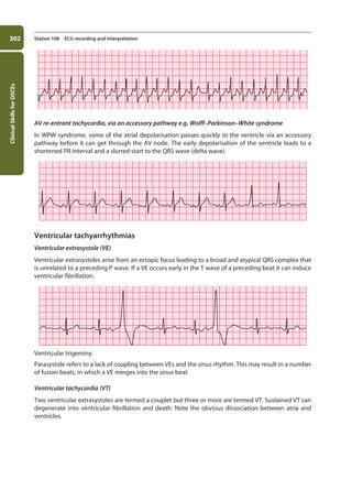 Clinical
Skills
for
OSCEs
302 Station 108 ECG recording and interpretation
AV re-entrant tachycardia, via an accessory pathway e.g. Wolff–Parkinson–White syndrome
In WPW syndrome, some of the atrial depolarisation passes quickly to the ventricle via an accessory
pathway before it can get through the AV node. The early depolarisation of the ventricle leads to a
shortened PR interval and a slurred start to the QRS wave (delta wave).
Ventricular tachyarrhythmias
Ventricular extrasystole (VE)
Ventricular extrasystoles arise from an ectopic focus leading to a broad and atypical QRS complex that
is unrelated to a preceding P wave. If a VE occurs early in the T wave of a preceding beat it can induce
ventricular fibrillation.
Ventricular trigeminy.
Parasystole refers to a lack of coupling between VEs and the sinus rhythm. This may result in a number
of fusion beats, in which a VE merges into the sinus beat.
Ventricular tachycardia (VT)
Two ventricular extrasystoles are termed a couplet but three or more are termed VT. Sustained VT can
degenerate into ventricular fibrillation and death. Note the obvious dissociation between atria and
ventricles.
11-OCSEs-Data_interpretation_5e ccp.indd 302 19/03/2015 13:39
 