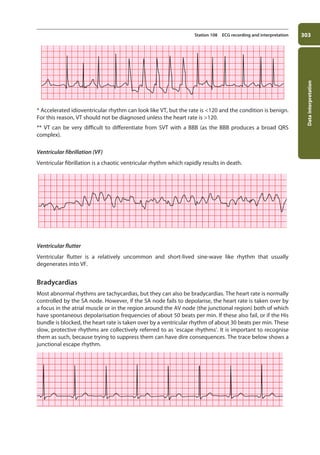 Data
interpretation
303
Station 108 ECG recording and interpretation
* Accelerated idioventricular rhythm can look like VT, but the rate is 120 and the condition is benign.
For this reason, VT should not be diagnosed unless the heart rate is 120.
** VT can be very difficult to differentiate from SVT with a BBB (as the BBB produces a broad QRS
complex).
Ventricular fibrillation (VF)
Ventricular fibrillation is a chaotic ventricular rhythm which rapidly results in death.
Ventricular flutter
Ventricular flutter is a relatively uncommon and short-lived sine-wave like rhythm that usually
degenerates into VF.
Bradycardias
Most abnormal rhythms are tachycardias, but they can also be bradycardias. The heart rate is normally
controlled by the SA node. However, if the SA node fails to depolarise, the heart rate is taken over by
a focus in the atrial muscle or in the region around the AV node (the junctional region) both of which
have spontaneous depolarisation frequencies of about 50 beats per min. If these also fail, or if the His
bundle is blocked, the heart rate is taken over by a ventricular rhythm of about 30 beats per min. These
slow, protective rhythms are collectively referred to as ‘escape rhythms’. It is important to recognise
them as such, because trying to suppress them can have dire consequences. The trace below shows a
junctional escape rhythm.
11-OCSEs-Data_interpretation_5e ccp.indd 303 19/03/2015 13:39
 