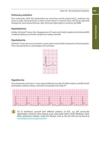 Data
interpretation
305
Station 108 ECG recording and interpretation
Pulmonary embolism
Sinus tachycardia. Other ECG abnormalities are uncommon and the classical SI
QIII
TIII
syndrome only
occurs in under 10% (prominent S in lead I, Q and inverted T in lead III). There may also be right atrial
enlargement, atrial tachyarrhythmias, right ventricular hypertrophy or ischaemia, and RBBB.
Hyperkalaemia
Initially, tall tented T waves, then disappearance of P waves and, finally, broadened and distorted QRS
complexes leading to ventricular arrhythmia or cardiac standstill.
Hypokalaemia
Flattened T waves and more prominent U waves which may be falsely interpreted as QT prolongation.
There may also be first or second degree AV heart block.
Hypothermia
Sinus bradycardia, prominent ‘J’ wave (upward deflection just after the QRS complex), and QRS and QT
prolongation, leading to blocks, ventricular extrasystoles and, finally, VF.
Try to familiarise yourself with different patterns of ECG, e.g. left ventricular
hypertrophy, ischaemic heart disease, acute myocardial infarct, atrial fibrillation, heart
block, pulmonary embolus. Study ECG libraries such as the one that can be found at
www.ecglibrary.com/ecghome.html.
11-OCSEs-Data_interpretation_5e ccp.indd 305 19/03/2015 13:39
 