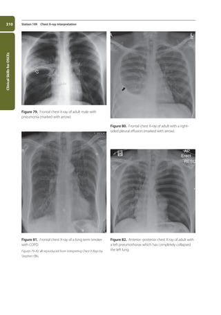 Clinical
Skills
for
OSCEs
310 Station 109 Chest X-ray interpretation
Figure 80. Frontal chest X-ray of adult with a right-
sided pleural effusion (marked with arrow).
Figure 82. Anterior–posterior chest X-ray of adult with
a left pneumothorax which has completely collapsed
the left lung.
Figure 81. Frontal chest X-ray of a long term smoker
with COPD.
Figures 79–82 all reproduced from Interpreting Chest X-Rays by
Stephen Ellis.
Figure 79. Frontal chest X-ray of adult male with
pneumonia (marked with arrow).
11-OCSEs-Data_interpretation_5e ccp.indd 310 19/03/2015 13:39
 