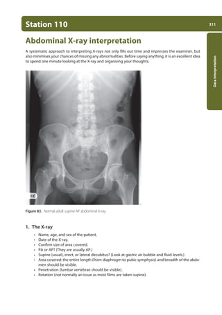 311
Data
interpretation
Station 110
Abdominal X-ray interpretation
A systematic approach to interpreting X-rays not only fills out time and impresses the examiner, but
also minimises your chances of missing any abnormalities. Before saying anything, it is an excellent idea
to spend one minute looking at the X-ray and organising your thoughts.
Figure 83. Normal adult supine AP abdominal X-ray.
1. The X-ray
• Name, age, and sex of the patient.
• Date of the X-ray.
• Confirm size of area covered.
• PA or AP? (They are usually AP.)
• Supine (usual), erect, or lateral decubitus? (Look at gastric air bubble and fluid levels.)
• Area covered: the entire length (from diaphragm to pubic symphysis) and breadth of the abdo-
men should be visible.
• Penetration (lumbar vertebrae should be visible).
• Rotation (not normally an issue as most films are taken supine).
11-OCSEs-Data_interpretation_5e ccp.indd 311 19/03/2015 13:39
 