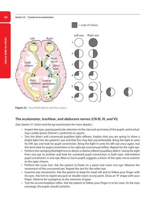 Clinical
Skills
for
OSCEs
82 Station 32 Cranial nerve examination
Figure 22. Visual field defects and their origins.
The oculomotor, trochlear, and abducens nerves (CN III, IV, and VI)
(See Station 51: Vision and the eye examination for more details.)
• Inspect the eyes, paying particular attention to the size and symmetry of the pupils, and exclud-
ing a visible ptosis (Horner’s syndrome) or squint.
• Test the direct and consensual pupillary light reflexes. Explain that you are going to shine a
bright light into the patient’s eye and that this may feel uncomfortable. Bring the light in onto
his left eye and look for pupil constriction. Bring the light in onto his left eye once again, but
this time look for pupil constriction in his right eye (consensual reflex). Repeat for the right eye.
• Perform the swinging flashlight test to detect a relative afferent pupillary defect. Swing the light
from one eye to another and look for sustained pupil constriction in both eyes. Intermittent
pupil constriction in one eye (Marcus Gunn pupil) suggests a lesion of the optic nerve anterior
to the optic chiasm.
• Perform the cover test. Ask the patient to fixate on a point and cover one eye. Observe the
movement of the uncovered eye. Repeat the test for the other eye.
• Examine eye movements. Ask the patient to keep his head still and to follow your finger with
his eyes. Ask him to report any pain or double vision at any point. Draw an ‘H’ shape with your
finger. Observe for nystagmus at the extremes of gaze.
• Test the accommodation reflex. Ask the patient to follow your finger in to his nose. As the eyes
converge, the pupils should constrict.
Optic
radiation
Lateral
geniculate
body
Optic
tract
Optic
chiasm
Left Right
Left eye
 Loss of vision
1
2
3
4
5
6
Right eye
Optic
nerve
5
6
3
4
2
1
04-OCSEs-Neurology_5e ccp.indd 82 19/03/2015 12:34
 