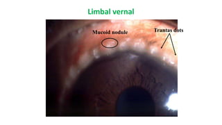 Clinical 5th Grade Dr Ahmed Osama Hashem Ophthalmology.pptx