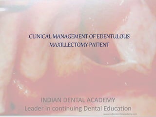 CLINICAL MANAGEMENT OF EDENTULOUS
MAXILLECTOMY PATIENT
INDIAN DENTAL ACADEMY
Leader in continuing Dental Education
www.indiandentalacademy.com
 