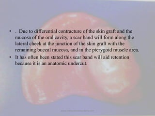 • . Due to differential contracture of the skin graft and the
mucosa of the oral cavity, a scar band will form along the
l...