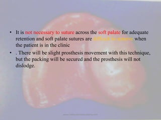 • It is not necessary to suture across the soft palate for adequate
retention and soft palate sutures are difficult to rem...