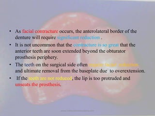 • As facial contracture occurs, the anterolateral border of the
denture will require significant reduction .
• It is not u...