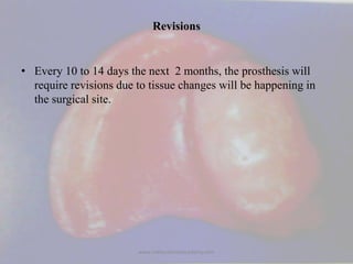 Revisions
• Every 10 to 14 days the next 2 months, the prosthesis will
require revisions due to tissue changes will be hap...
