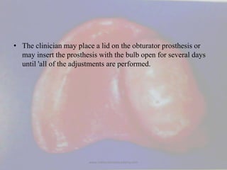 • The clinician may place a lid on the obturator prosthesis or
may insert the prosthesis with the bulb open for several da...
