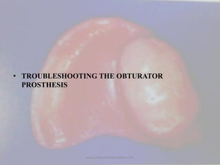 • TROUBLESHOOTING THE OBTURATOR
PROSTHESIS
www.indiandentalacademy.com
 