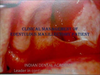 CLINICAL MANAGEMENT OF
EDENTULOUS MAXILLECTOMY PATIENT
INDIAN DENTAL ACADEMY
Leader in continuing Dental Educationwww.indiandentalacademy.com
 