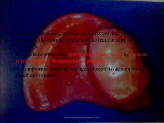 • Without maximum extension of the record one cannot
determine the optimal position of the teeth to support the lip
and ch...