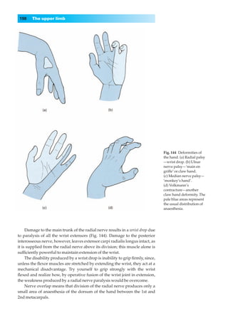198    The upper limb




                                                                                  Fig. 144◊Deformities of
                                                                                  the hand. (a) Radial palsy
                                                                                  —wrist drop. (b) Ulnar
                                                                                  nerve palsy—‘main en
                                                                                  griffe’ or claw hand.
                                                                                  (c) Median nerve palsy—
                                                                                  ‘monkey’s hand’.
                                                                                  (d) Volkmann’s
                                                                                  contracture—another
                                                                                  claw hand deformity. The
                                                                                  pale blue areas represent
                                                                                  the usual distribution of
                                                                                  anaesthesia.




     Damage to the main trunk of the radial nerve results in a wrist drop due
to paralysis of all the wrist extensors (Fig. 144). Damage to the posterior
interosseous nerve, however, leaves extensor carpi radialis longus intact, as
it is supplied from the radial nerve above its division; this muscle alone is
sufﬁciently powerful to maintain extension of the wrist.
     The disability produced by a wrist drop is inability to grip ﬁrmly, since,
unless the ﬂexor muscles are stretched by extending the wrist, they act at a
mechanical disadvantage. Try yourself to grip strongly with the wrist
ﬂexed and realize how, by operative fusion of the wrist joint in extension,
the weakness produced by a radial nerve paralysis would be overcome.
     Nerve overlap means that division of the radial nerve produces only a
small area of anaesthesia of the dorsum of the hand between the 1st and
2nd metacarpals.
 