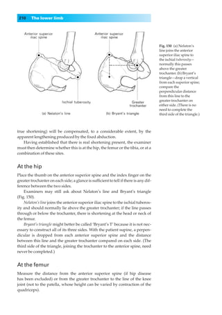 210    The lower limb




                                                                                      Fig. 150◊(a) Nelaton’s
                                                                                      line joins the anterior
                                                                                      superior iliac spine to
                                                                                      the ischial tuberosity—
                                                                                      normally this passes
                                                                                      above the greater
                                                                                      trochanter. (b) Bryant’s
                                                                                      triangle—drop a vertical
                                                                                      from each superior spine;
                                                                                      compare the
                                                                                      perpendicular distance
                                                                                      from this line to the
                                                                                      greater trochanter on
                                                                                      either side. (There is no
                                                                                      need to complete the
                                                                                      third side of the triangle.)



true shortening) will be compensated, to a considerable extent, by the
apparent lengthening produced by the ﬁxed abduction.
    Having established that there is real shortening present, the examiner
must then determine whether this is at the hip, the femur or the tibia, or at a
combination of these sites.


At the hip
Place the thumb on the anterior superior spine and the index ﬁnger on the
greater trochanter on each side; a glance is sufﬁcient to tell if there is any dif-
ference between the two sides.
    Examiners may still ask about Nelaton’s line and Bryant’s triangle
(Fig. 150).
    Nelaton’s line joins the anterior superior iliac spine to the ischial tuberos-
ity and should normally lie above the greater trochanter; if the line passes
through or below the trochanter, there is shortening at the head or neck of
the femur.
    Bryant’s triangle might better be called ‘Bryant’s T’ because it is not nec-
essary to construct all of its three sides. With the patient supine, a perpen-
dicular is dropped from each anterior superior spine and the distance
between this line and the greater trochanter compared on each side. (The
third side of the triangle, joining the trochanter to the anterior spine, need
never be completed.)


At the femur
Measure the distance from the anterior superior spine (if hip disease
has been excluded) or from the greater trochanter to the line of the knee
joint (not to the patella, whose height can be varied by contraction of the
quadriceps).
 
