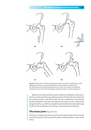 The bones and joints of the lower limb                     229




Fig. 168◊Dislocation of the hip. If the hip is forced into posterior dislocation while
adducted (a), there is no associated fracture of the posterior acetabular lip
(b). Dislocation in the abducted position (c) can only occur with a concomitant
acetabular fracture (d). (The inset ﬁgure indicates the plane of these diagrams.)


    Reduction of a dislocated hip is quite simple providing that a deep anaes-
thetic is used to relax the surrounding muscles; the hip is ﬂexed, rotated into
the neutral position and lifted back into the acetabulum. Occasionally,
forcible abduction of the hip will dislocate the hip forwards. Violent force
along the shaft (e.g. a fall from a height) may thrust the femoral head through
the ﬂoor of the acetabulum, producing a central dislocation of the hip.


The knee joint (Figs 169, 170)
The knee is a hinge joint made up of the articulations between the femoral
and tibial condyles and between the patella and the patellar surface of the
femur.
 
