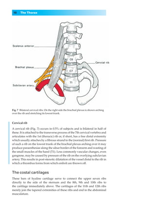 10    The Thorax




Fig. 7◊Bilateral cervical ribs. On the right side the brachial plexus is shown arching
over the rib and stretching its lowest trunk.


Cervical rib

A cervical rib (Fig. 7) occurs in 0.5% of subjects and is bilateral in half of
these. It is attached to the transverse process of the 7th cervical vertebra and
articulates with the 1st (thoracic) rib or, if short, has a free distal extremity
which usually attaches by a ﬁbrous strand to the (normal) ﬁrst rib. Pressure
of such a rib on the lowest trunk of the brachial plexus arching over it may
produce paraesthesiae along the ulnar border of the forearm and wasting of
the small muscles of the hand (T1). Less commonly vascular changes, even
gangrene, may be caused by pressure of the rib on the overlying subclavian
artery. This results in post-stenotic dilatation of the vessel distal to the rib in
which a thrombus forms from which emboli are thrown off.


The costal cartilages
These bars of hyaline cartilage serve to connect the upper seven ribs
directly to the side of the sternum and the 8th, 9th and 10th ribs to
the cartilage immediately above. The cartilages of the 11th and 12th ribs
merely join the tapered extremities of these ribs and end in the abdominal
musculature.
 