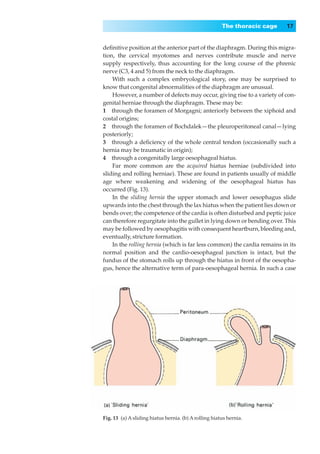 The thoracic cage   17


deﬁnitive position at the anterior part of the diaphragm. During this migra-
tion, the cervical myotomes and nerves contribute muscle and nerve
supply respectively, thus accounting for the long course of the phrenic
nerve (C3, 4 and 5) from the neck to the diaphragm.
    With such a complex embryological story, one may be surprised to
know that congenital abnormalities of the diaphragm are unusual.
    However, a number of defects may occur, giving rise to a variety of con-
genital herniae through the diaphragm. These may be:
1◊◊through the foramen of Morgagni; anteriorly between the xiphoid and
costal origins;
2◊◊through the foramen of Bochdalek — the pleuroperitoneal canal — lying
posteriorly;
3◊◊through a deﬁciency of the whole central tendon (occasionally such a
hernia may be traumatic in origin);
4◊◊through a congenitally large oesophageal hiatus.
    Far more common are the acquired hiatus herniae (subdivided into
sliding and rolling herniae). These are found in patients usually of middle
age where weakening and widening of the oesophageal hiatus has
occurred (Fig. 13).
    In the sliding hernia the upper stomach and lower oesophagus slide
upwards into the chest through the lax hiatus when the patient lies down or
bends over; the competence of the cardia is often disturbed and peptic juice
can therefore regurgitate into the gullet in lying down or bending over. This
may be followed by oesophagitis with consequent heartburn, bleeding and,
eventually, stricture formation.
    In the rolling hernia (which is far less common) the cardia remains in its
normal position and the cardio-oesophageal junction is intact, but the
fundus of the stomach rolls up through the hiatus in front of the oesopha-
gus, hence the alternative term of para-oesophageal hernia. In such a case




Fig. 13◊(a) A sliding hiatus hernia. (b) A rolling hiatus hernia.
 